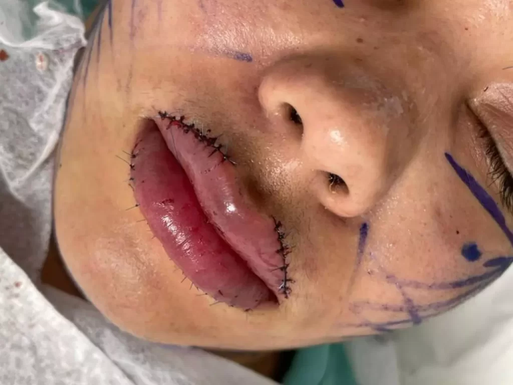 ‘Retirei cerca de 60% e o PMMA não era facial’, diz cirurgiã que atendeu vítima da ‘golpista do bocão’